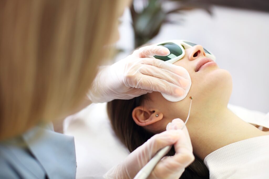 Laser mole removal on a woman's cheek in a beauty salon
